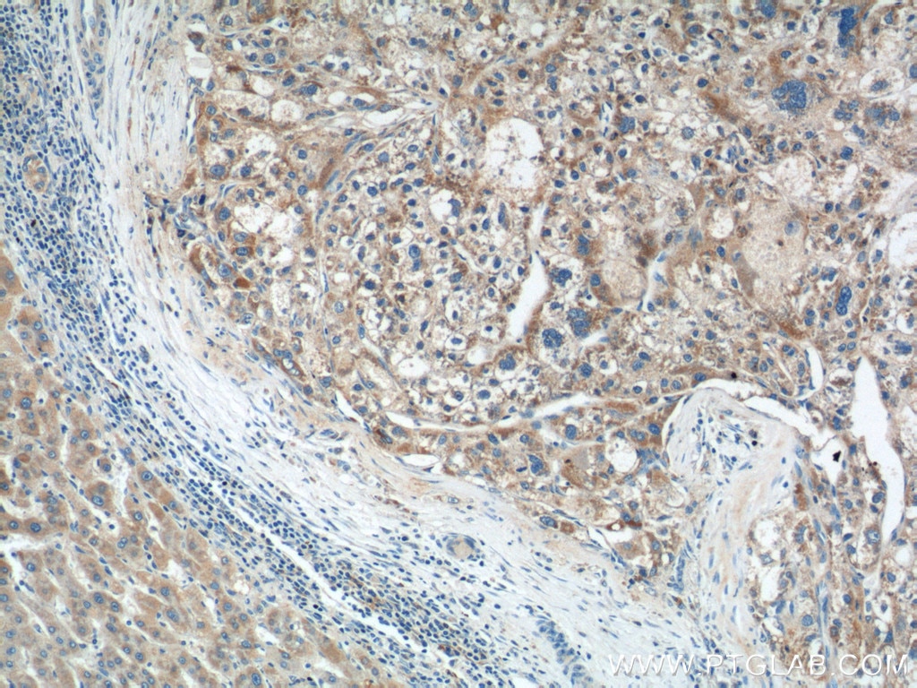 Immunohistochemistry (IHC) staining of human liver cancer tissue using MICB Polyclonal antibody (14325-1-AP)