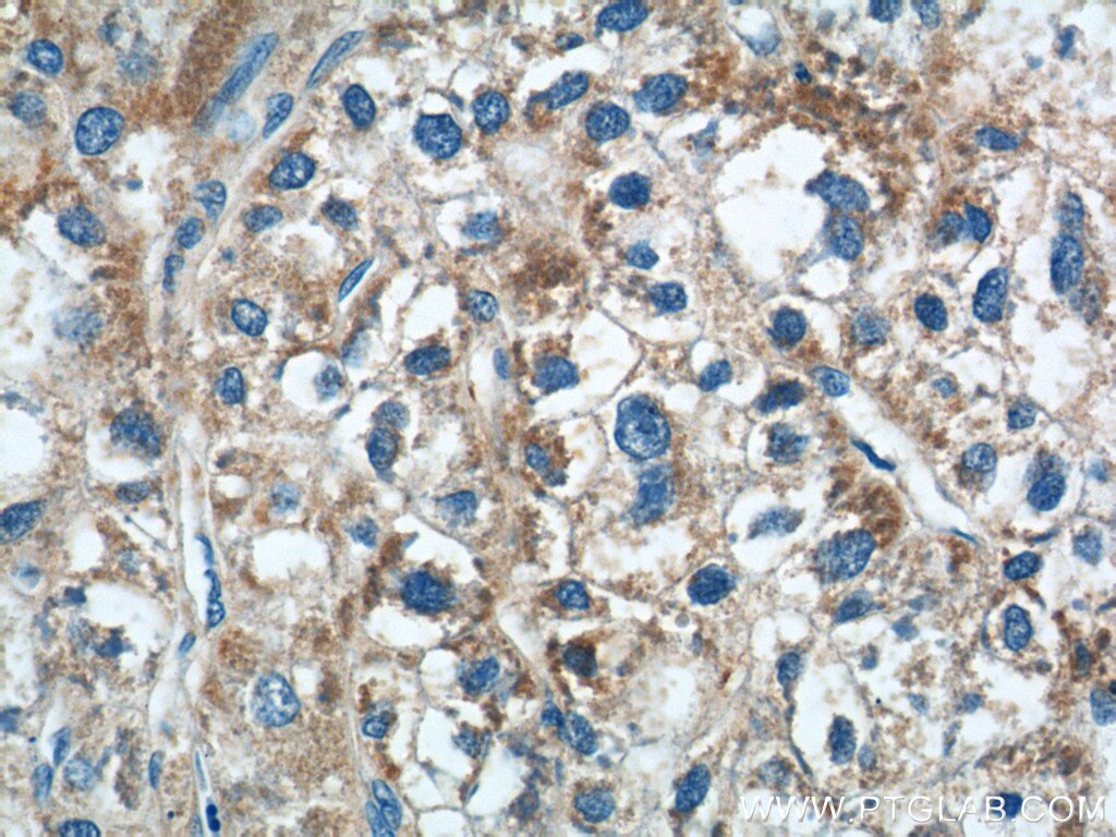 Immunohistochemistry (IHC) staining of human liver cancer tissue using MICB Polyclonal antibody (14325-1-AP)