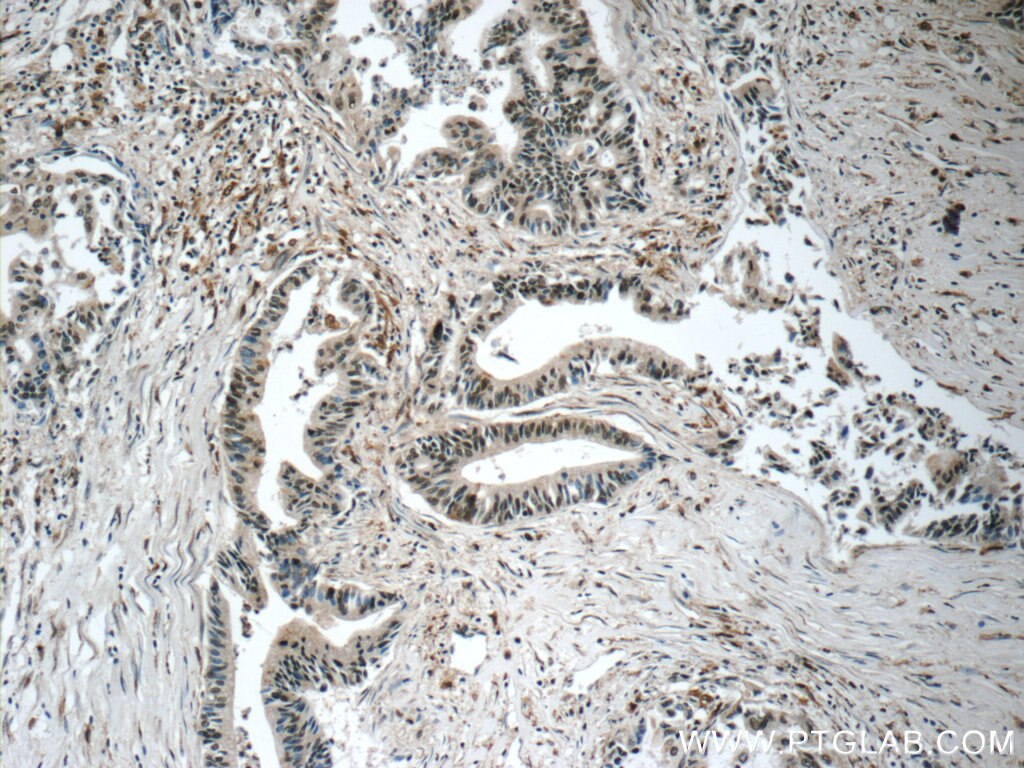 Immunohistochemistry (IHC) staining of human pancreas cancer tissue using MIER1 Polyclonal antibody (11452-1-AP)