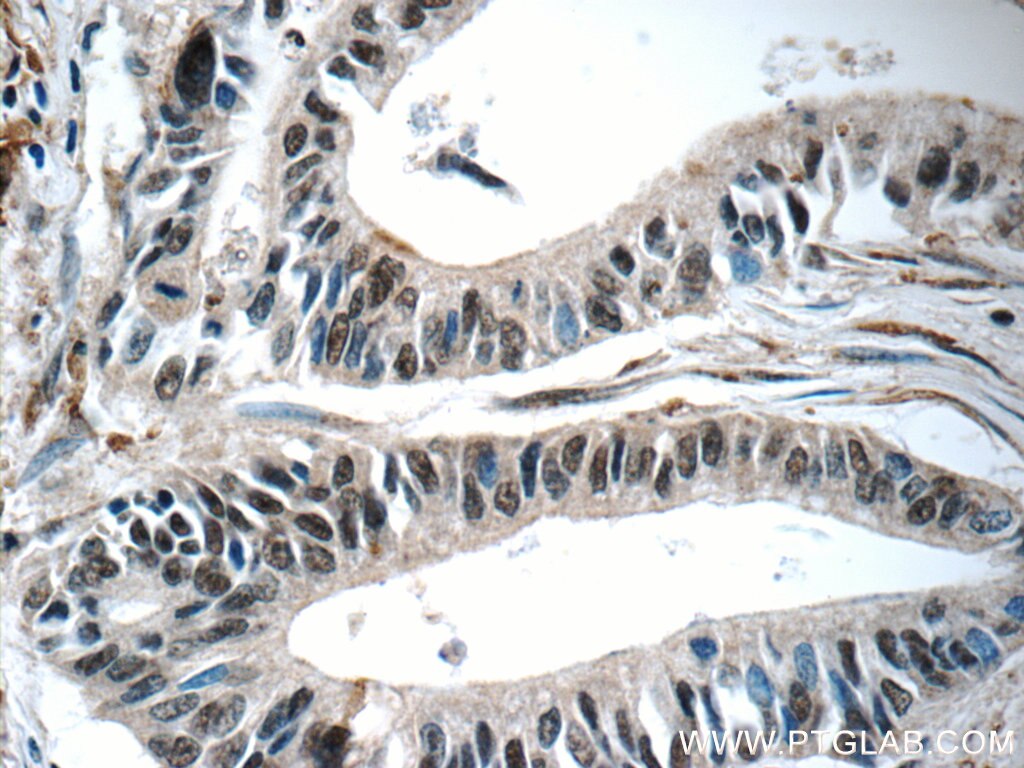 Immunohistochemistry (IHC) staining of human pancreas cancer tissue using MIER1 Polyclonal antibody (11452-1-AP)