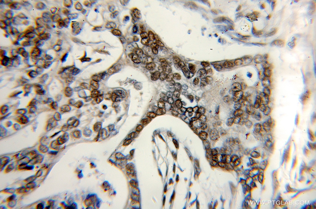 IHC staining of human pancreas cancer using 11452-1-AP