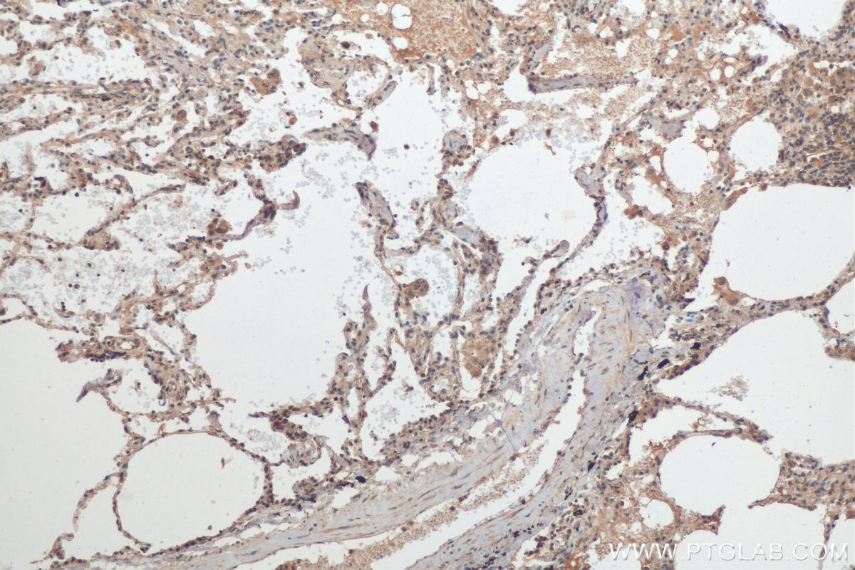 Immunohistochemistry (IHC) staining of human lung cancer tissue using MIG Polyclonal antibody (22355-1-AP)