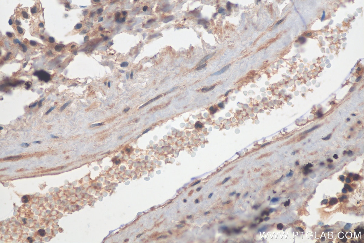 Immunohistochemistry (IHC) staining of human lung cancer tissue using MIG Polyclonal antibody (22355-1-AP)