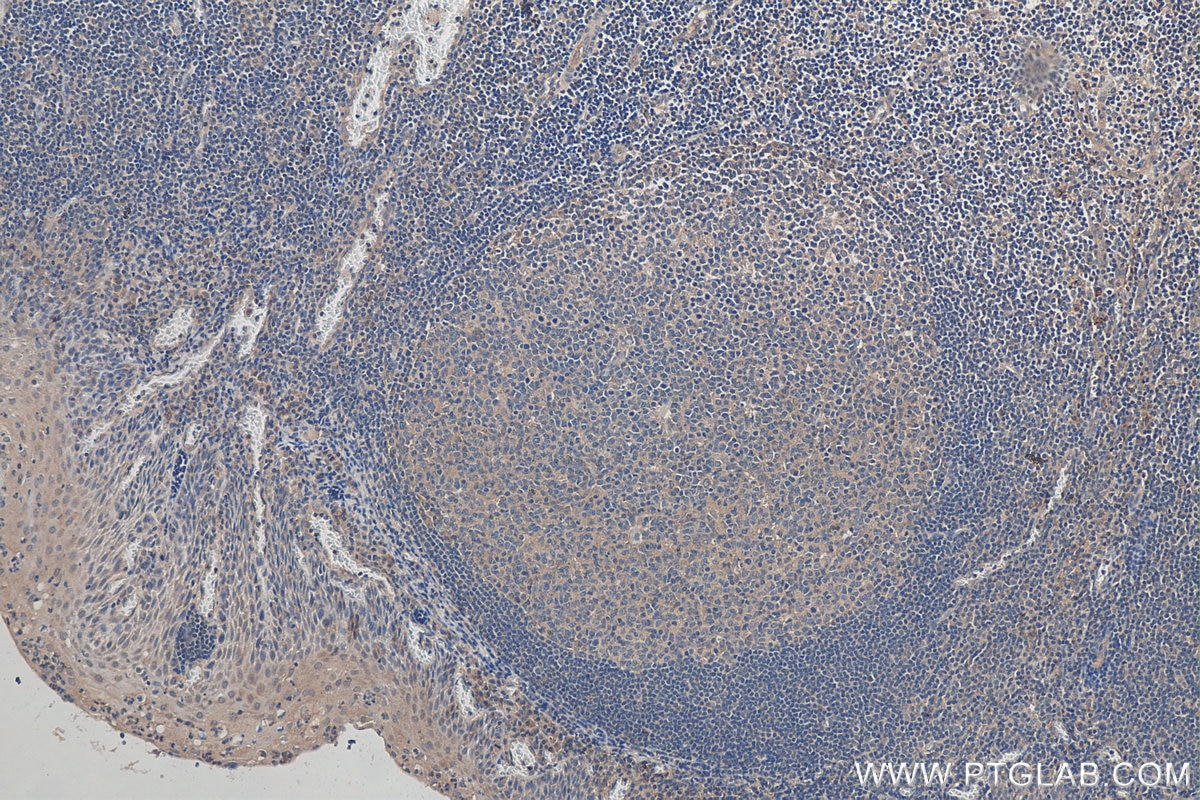 Immunohistochemistry (IHC) staining of human tonsillitis tissue using MIG Polyclonal antibody (22355-1-AP)