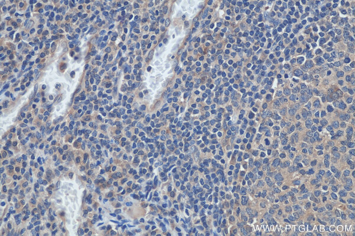 Immunohistochemistry (IHC) staining of human tonsillitis tissue using MIG Polyclonal antibody (22355-1-AP)