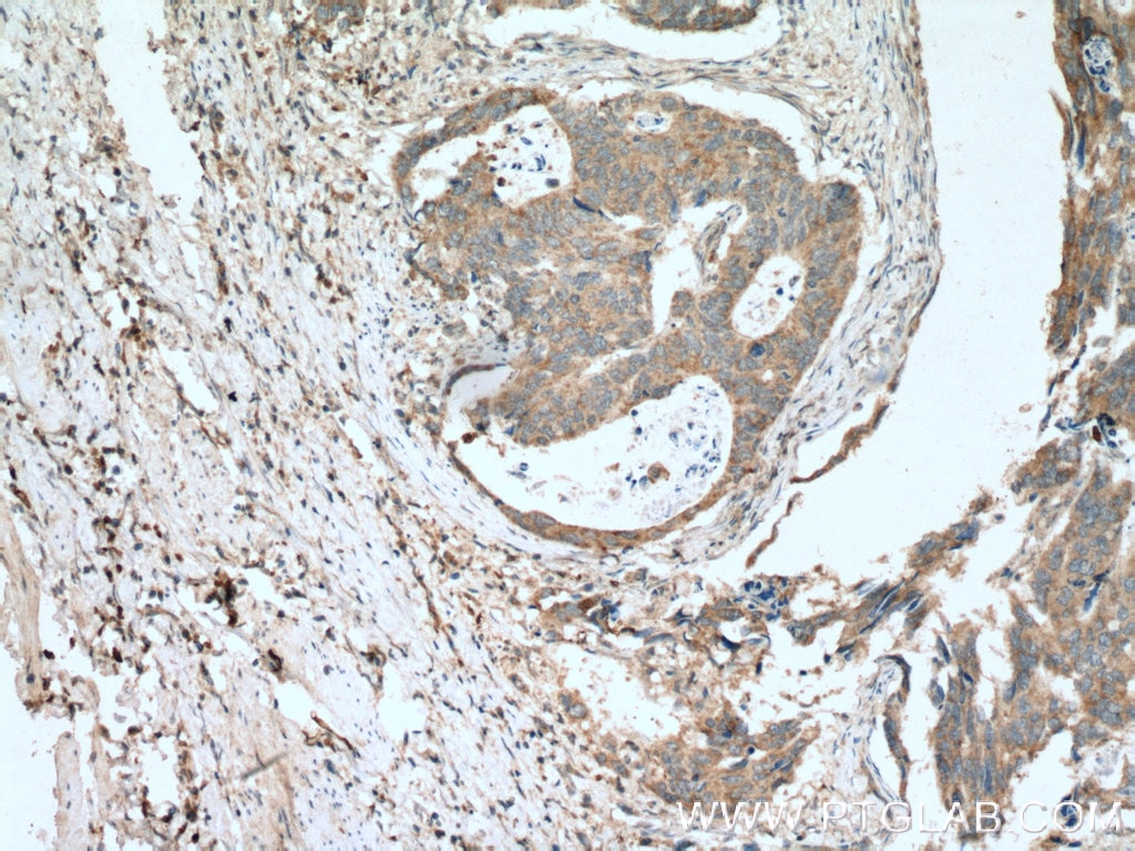 Immunohistochemistry (IHC) staining of human colon cancer tissue using MIG Polyclonal antibody (22355-1-AP)