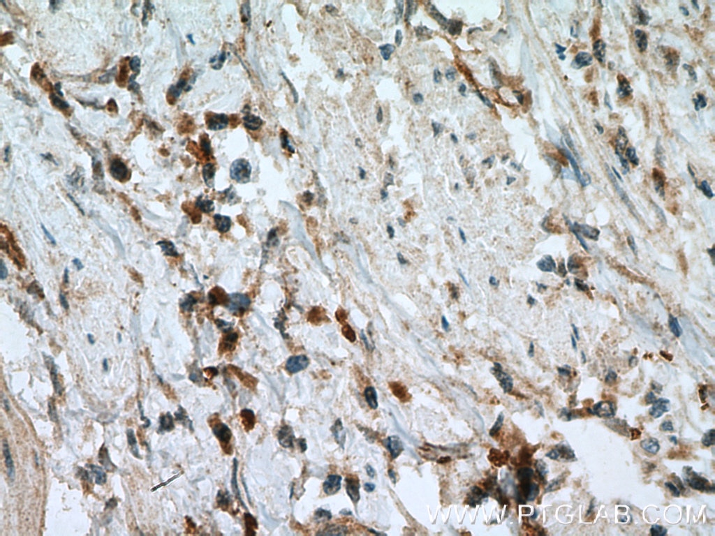 Immunohistochemistry (IHC) staining of human colon cancer tissue using MIG Polyclonal antibody (22355-1-AP)