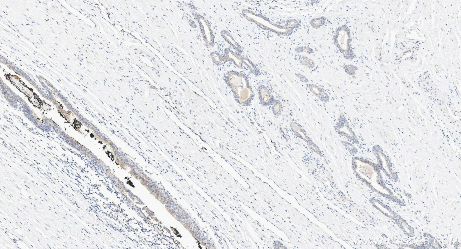 Immunohistochemistry (IHC) staining of human prostate cancer tissue using CXCL9/MIG Polyclonal antibody (22355-1-AP)