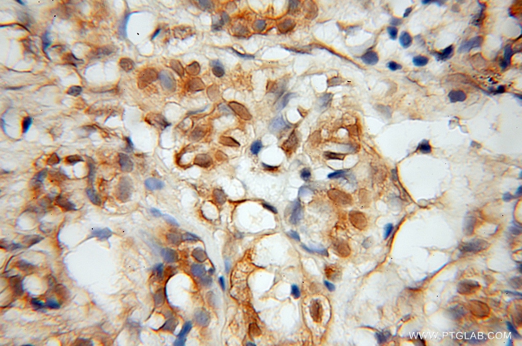 Immunohistochemistry (IHC) staining of human pancreas cancer tissue using MINA Polyclonal antibody (12214-1-AP)