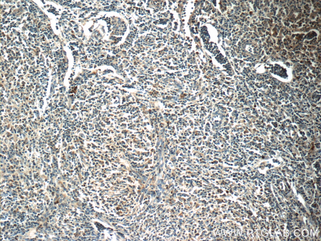 Immunohistochemistry (IHC) staining of human lymphoma tissue using MINK1 Polyclonal antibody (13137-1-AP)