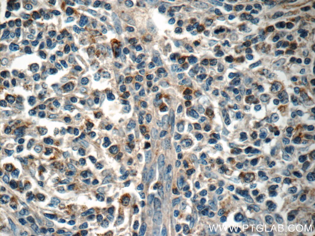 Immunohistochemistry (IHC) staining of human lymphoma tissue using MINK1 Polyclonal antibody (13137-1-AP)