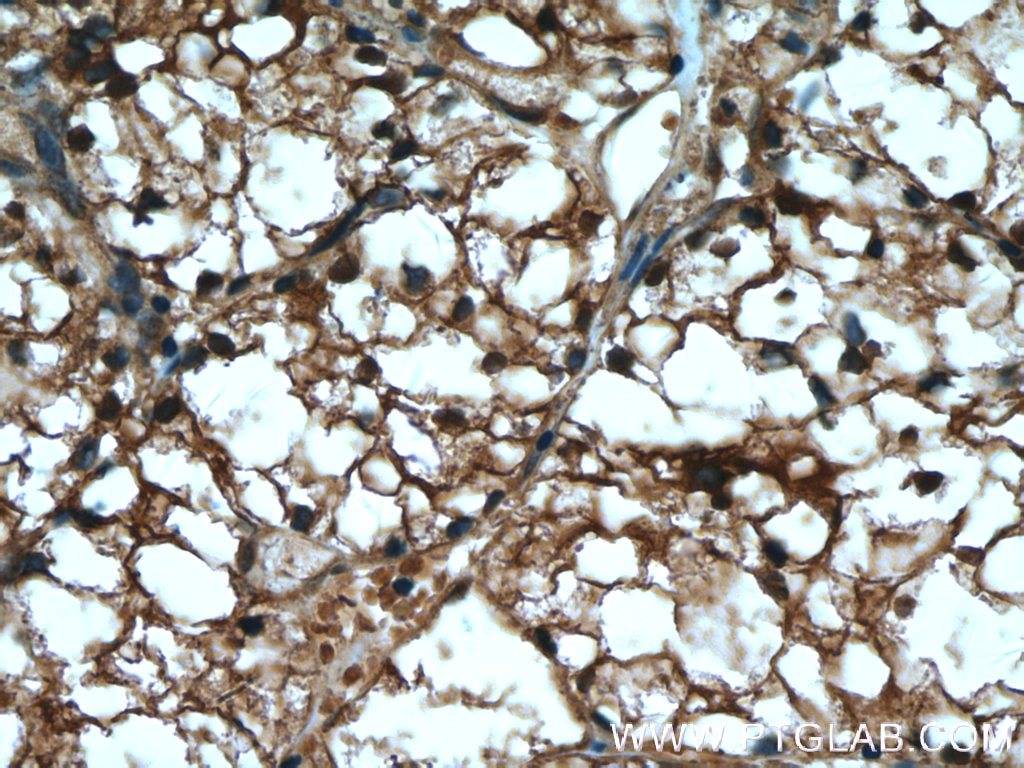 Immunohistochemistry (IHC) staining of human renal cell carcinoma tissue using MIOX Polyclonal antibody (17623-1-AP)