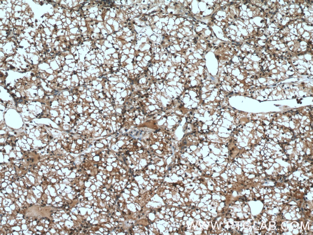 Immunohistochemistry (IHC) staining of human renal cell carcinoma tissue using MIOX Polyclonal antibody (17623-1-AP)