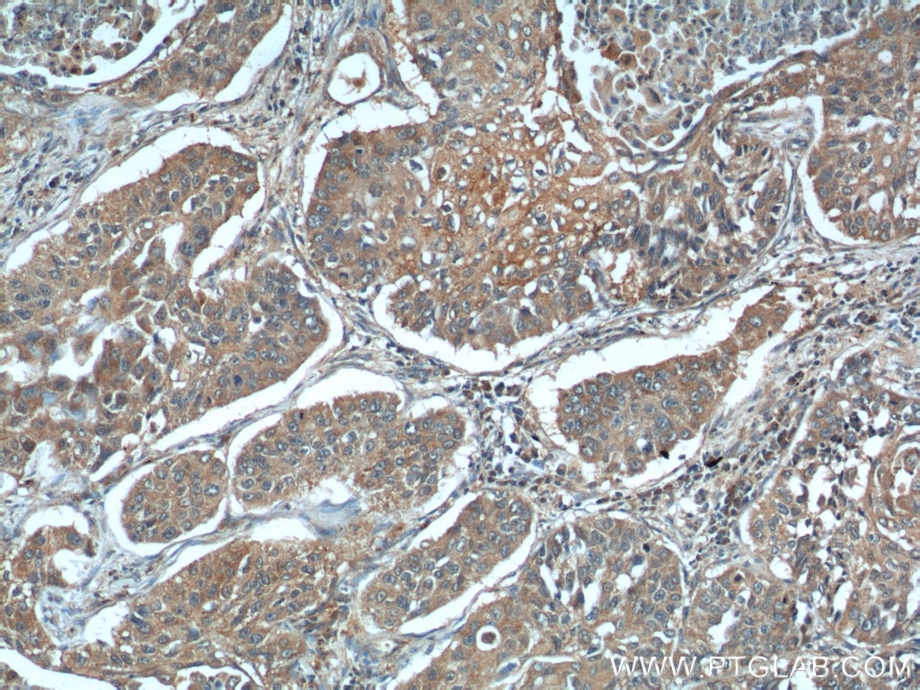Immunohistochemistry (IHC) staining of human lung cancer tissue using MIP-3 Alpha Polyclonal antibody (26527-1-AP)