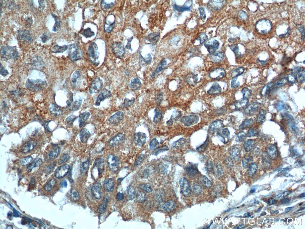 Immunohistochemistry (IHC) staining of human lung cancer tissue using MIP-3 Alpha Polyclonal antibody (26527-1-AP)