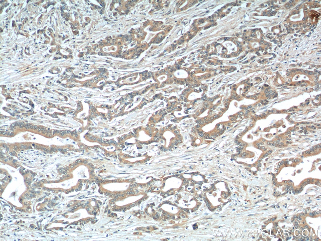 Immunohistochemistry (IHC) staining of human pancreas cancer tissue using MIP-3 Alpha Polyclonal antibody (26527-1-AP)