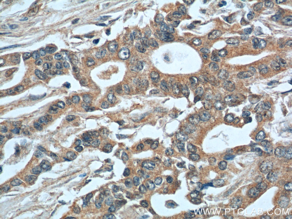 Immunohistochemistry (IHC) staining of human pancreas cancer tissue using MIP-3 Alpha Polyclonal antibody (26527-1-AP)