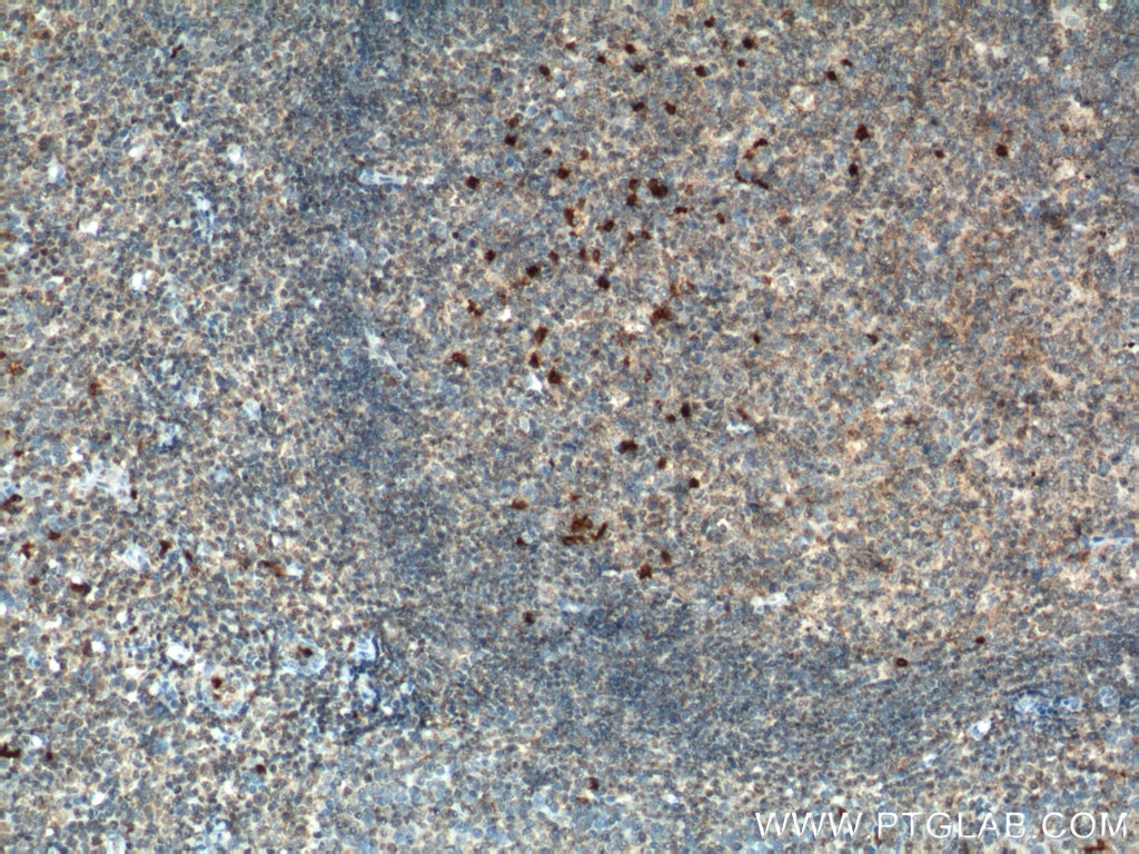 Immunohistochemistry (IHC) staining of human tonsillitis tissue using MIP-3 Alpha Polyclonal antibody (26527-1-AP)