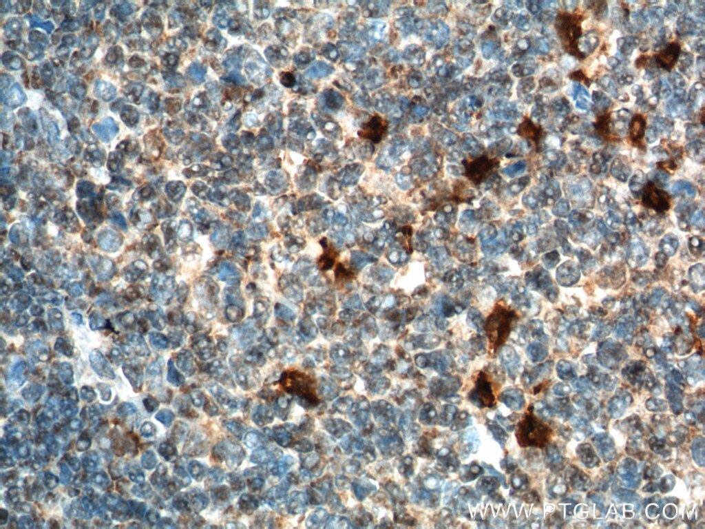 IHC staining of human tonsillitis using 26527-1-AP