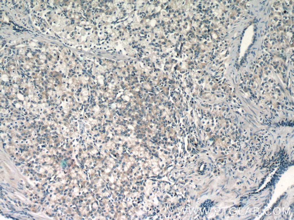 Immunohistochemistry (IHC) staining of human prostate cancer tissue using MIPEP Polyclonal antibody (11002-1-AP)