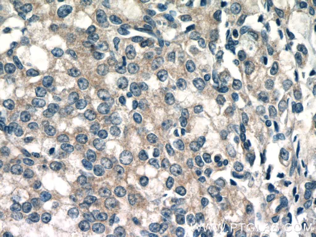 Immunohistochemistry (IHC) staining of human prostate cancer tissue using MIPEP Polyclonal antibody (11002-1-AP)