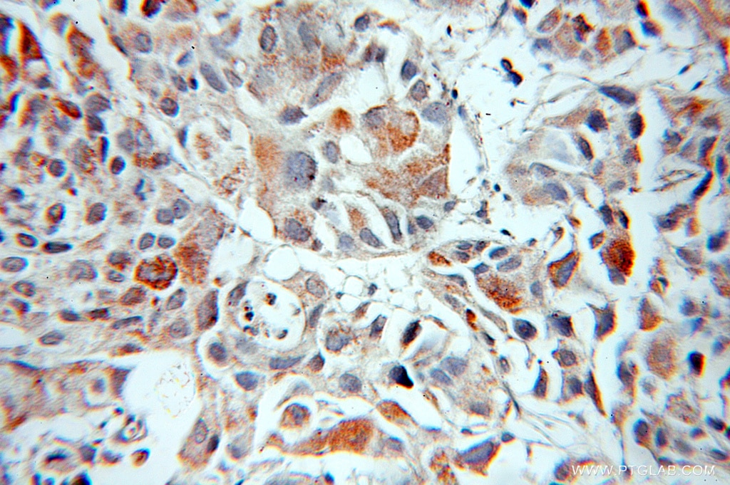 Immunohistochemistry (IHC) staining of human prostate cancer tissue using MIPEP Polyclonal antibody (11002-1-AP)