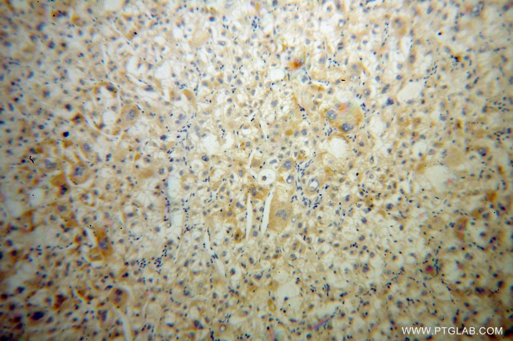 Immunohistochemistry (IHC) staining of human liver cancer tissue using MIPOL1 Polyclonal antibody (14158-1-AP)