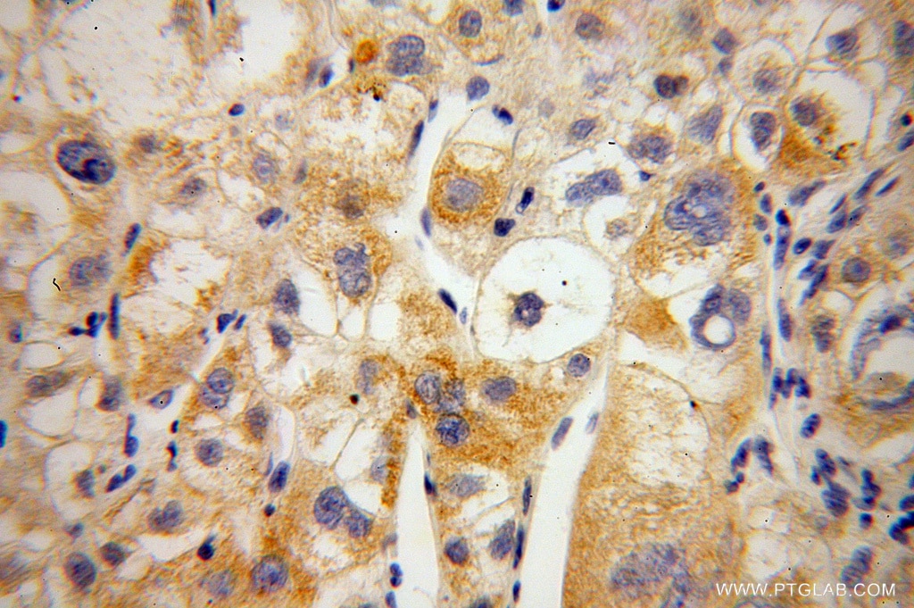 Immunohistochemistry (IHC) staining of human liver cancer tissue using MIPOL1 Polyclonal antibody (14158-1-AP)