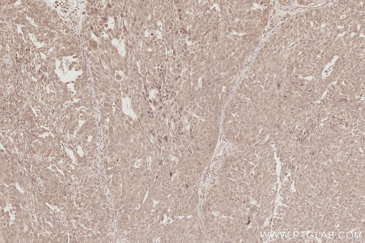 IHC staining of human ovary cancer using 19820-1-AP Immunohistochemistry (IHC) staining of human ovary cancer tissue using MIS12 Polyclonal antibody (19820-1-AP)