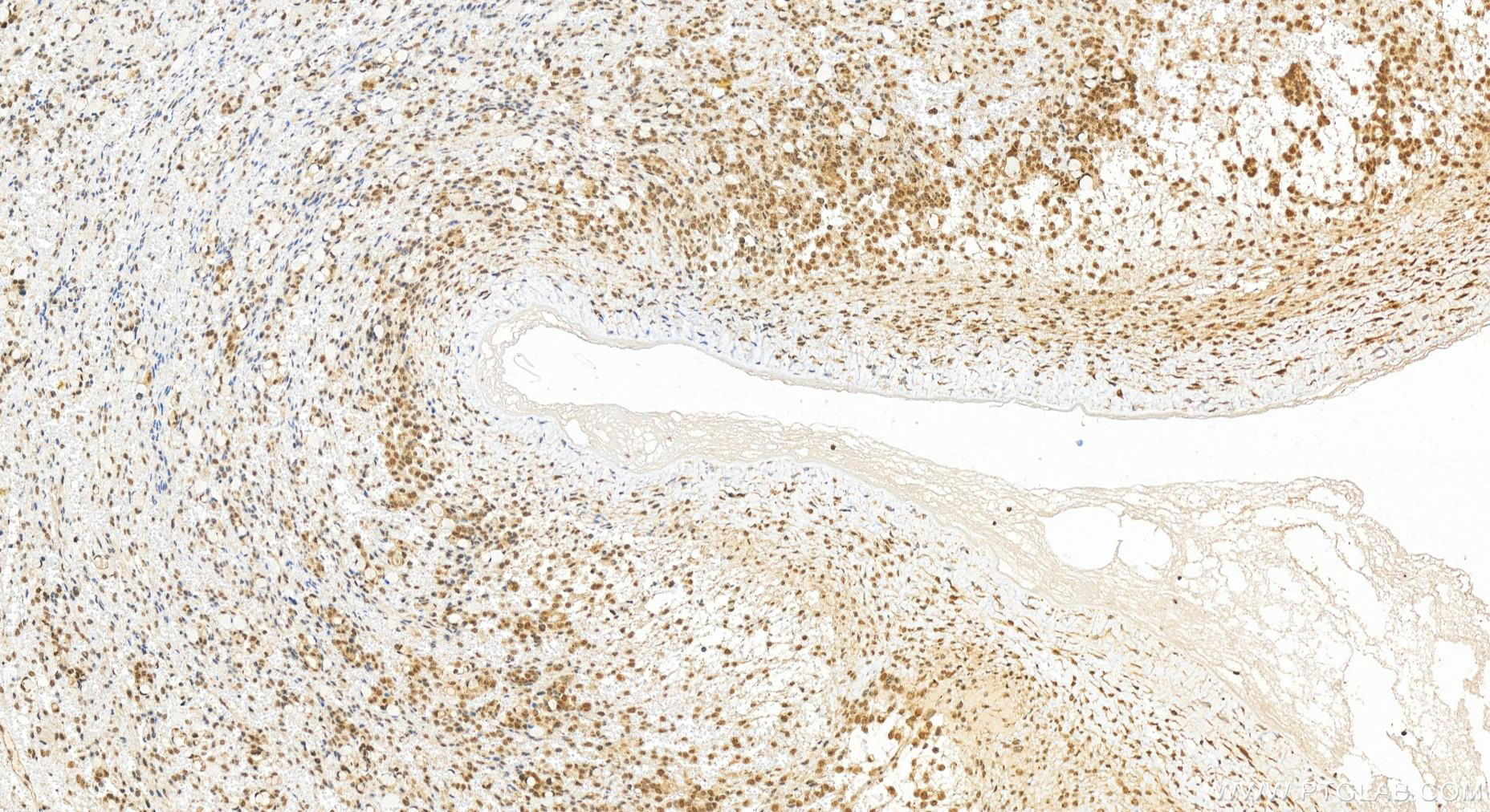 Immunohistochemical analysis of paraffin-embedded human ovary cancer tissue slide using 19820-1-AP (MIS12 antibody) at dilution of 1:400 (under 20x lens). Heat mediated antigen retrieval with Tris-EDTA buffer (pH 9.0). Immunohistochemistry (IHC) staining of human ovary cancer tissue using MIS12 Polyclonal antibody (19820-1-AP)