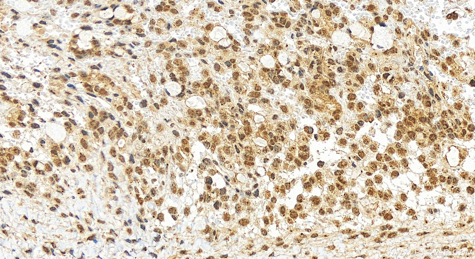 Immunohistochemical analysis of paraffin-embedded human ovary cancer tissue slide using 19820-1-AP (MIS12 antibody) at dilution of 1:400 (under 20x lens). Heat mediated antigen retrieval with Tris-EDTA buffer (pH 9.0). Immunohistochemistry (IHC) staining of human ovary cancer tissue using MIS12 Polyclonal antibody (19820-1-AP)