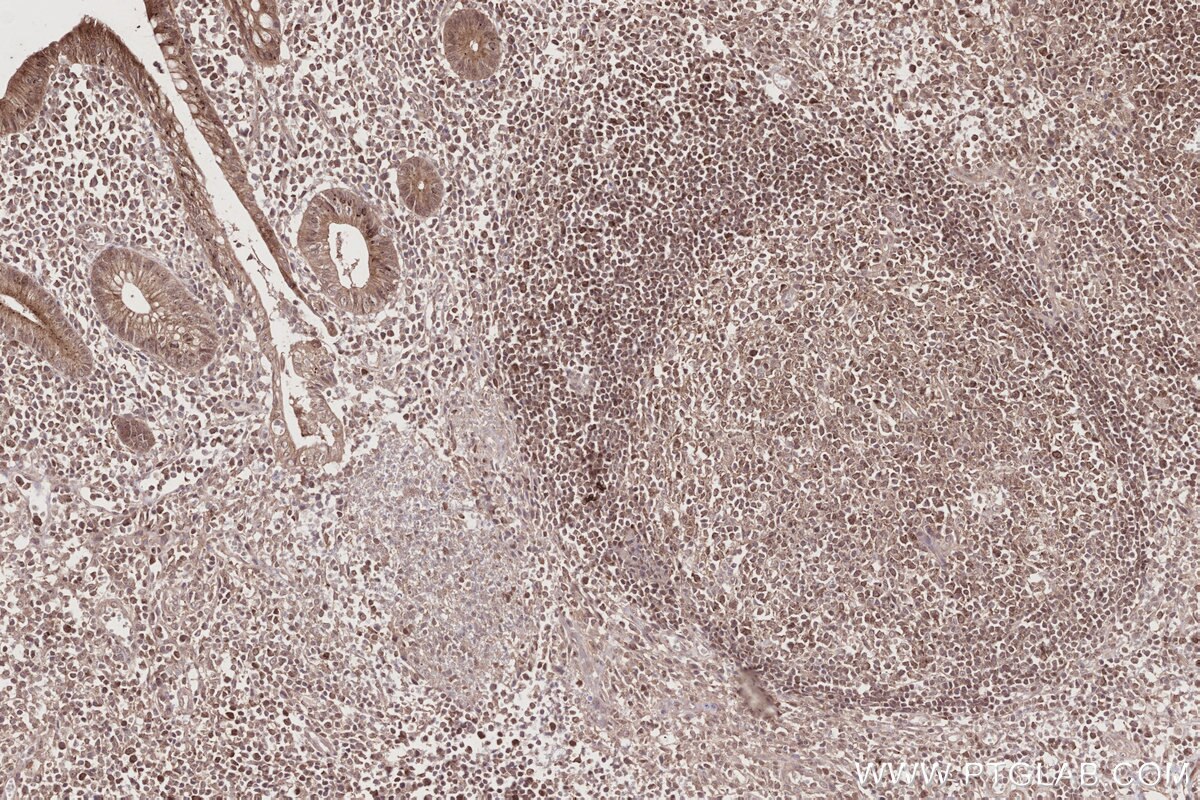 Immunohistochemistry (IHC) staining of human appendicitis tissue using MITD1 Polyclonal antibody (17264-1-AP)