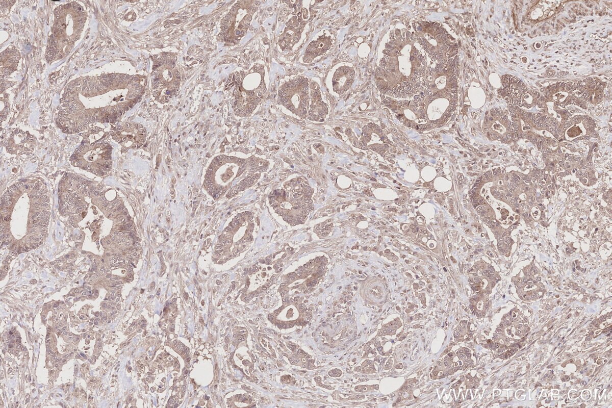 Immunohistochemistry (IHC) staining of human rectal cancer tissue using MITD1 Polyclonal antibody (17264-1-AP)