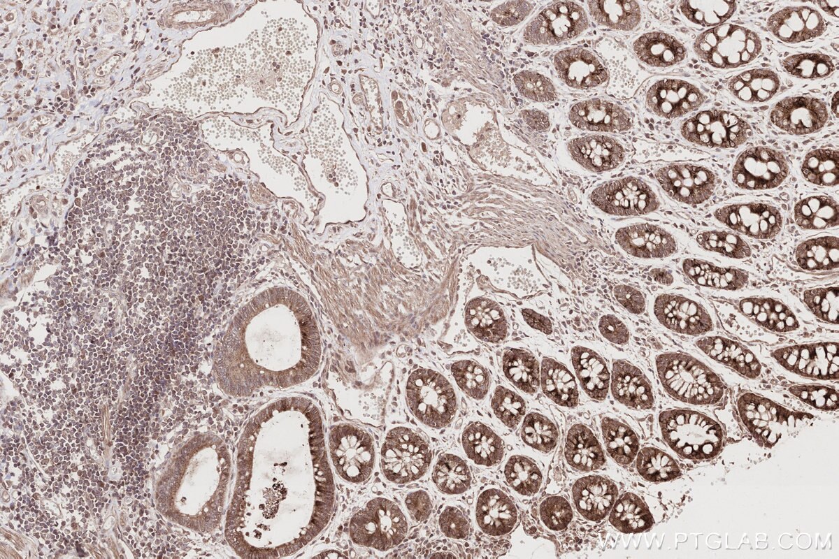 Immunohistochemistry (IHC) staining of human rectal cancer tissue using MITD1 Polyclonal antibody (17264-1-AP)