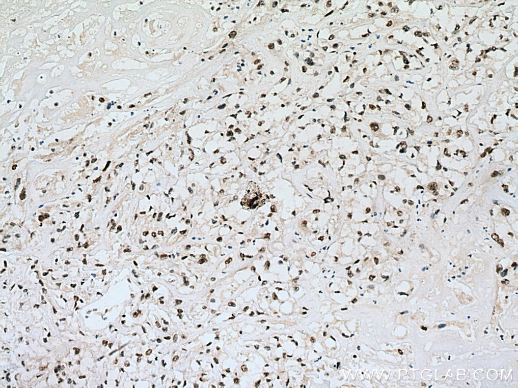 Immunohistochemistry (IHC) staining of human renal cell carcinoma tissue using NIFK Polyclonal antibody (12615-1-AP)