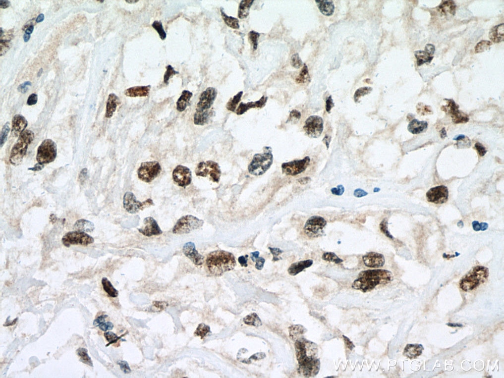 Immunohistochemistry (IHC) staining of human renal cell carcinoma tissue using NIFK Polyclonal antibody (12615-1-AP)