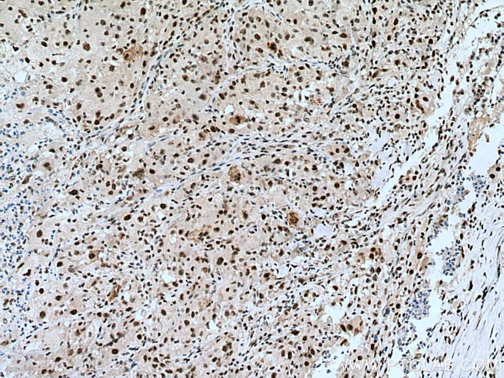 IHC staining of human liver cancer using 12615-1-AP