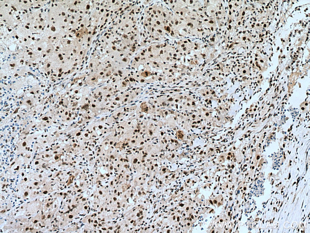 Immunohistochemistry (IHC) staining of human liver cancer tissue using NIFK Polyclonal antibody (12615-1-AP)