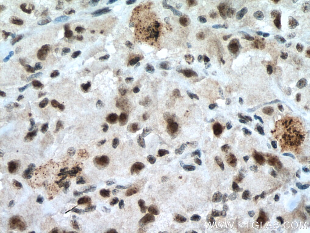 Immunohistochemistry (IHC) staining of human liver cancer tissue using NIFK Polyclonal antibody (12615-1-AP)