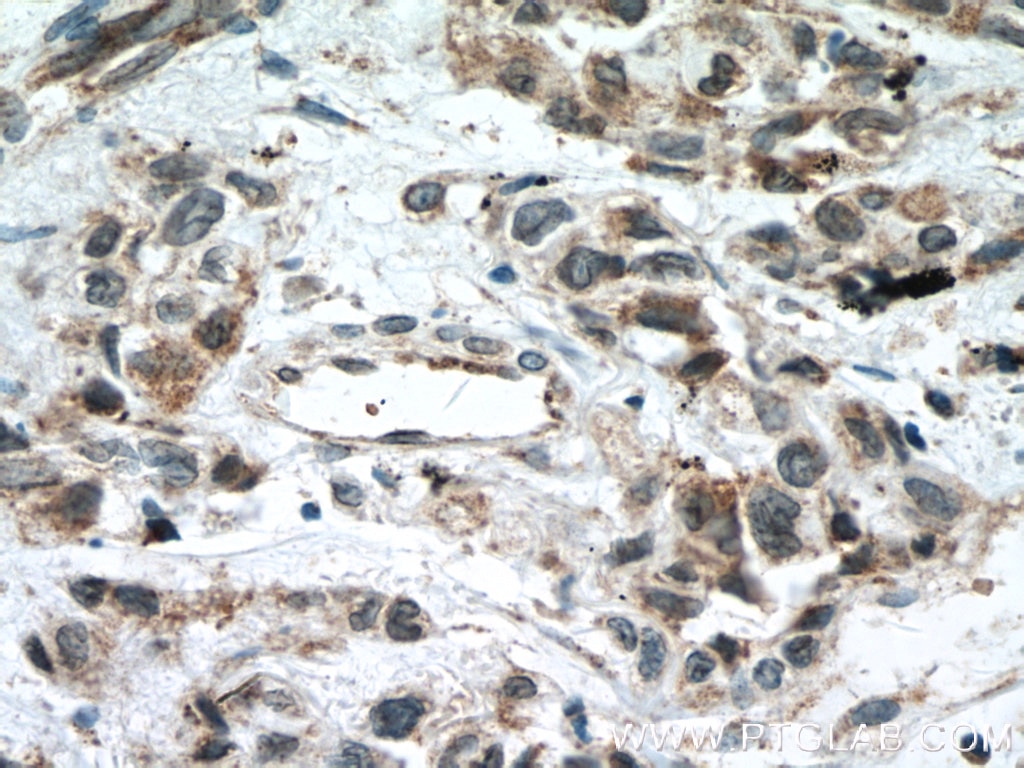 Immunohistochemistry (IHC) staining of human lung cancer tissue using MKK7 Polyclonal antibody (55030-1-AP)