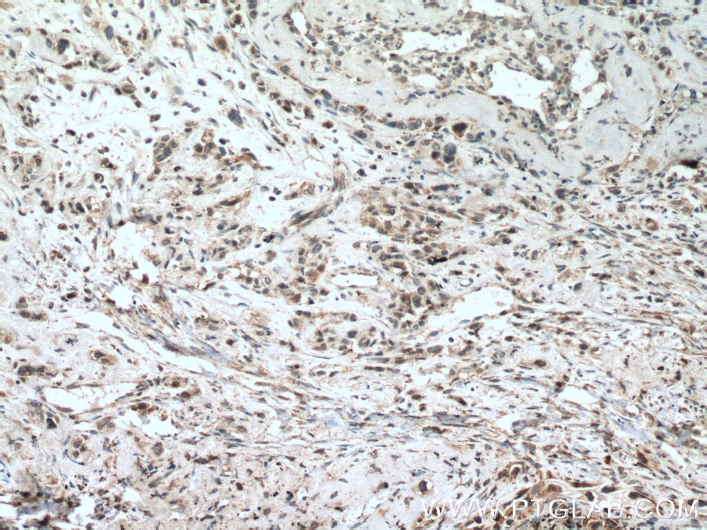 Immunohistochemistry (IHC) staining of human lung cancer tissue using MKK7 Polyclonal antibody (55030-1-AP)