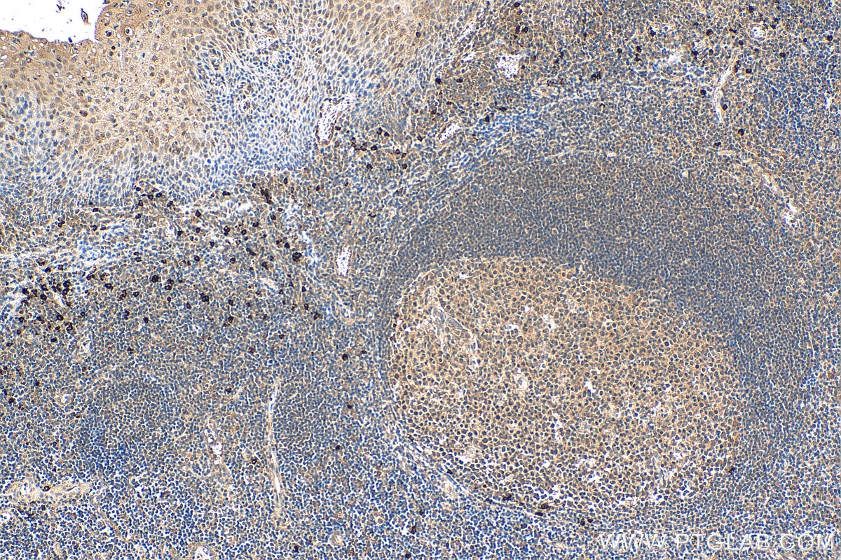 Immunohistochemistry (IHC) staining of human tonsillitis tissue using MKL1/MRTF-A Polyclonal antibody (21166-1-AP)