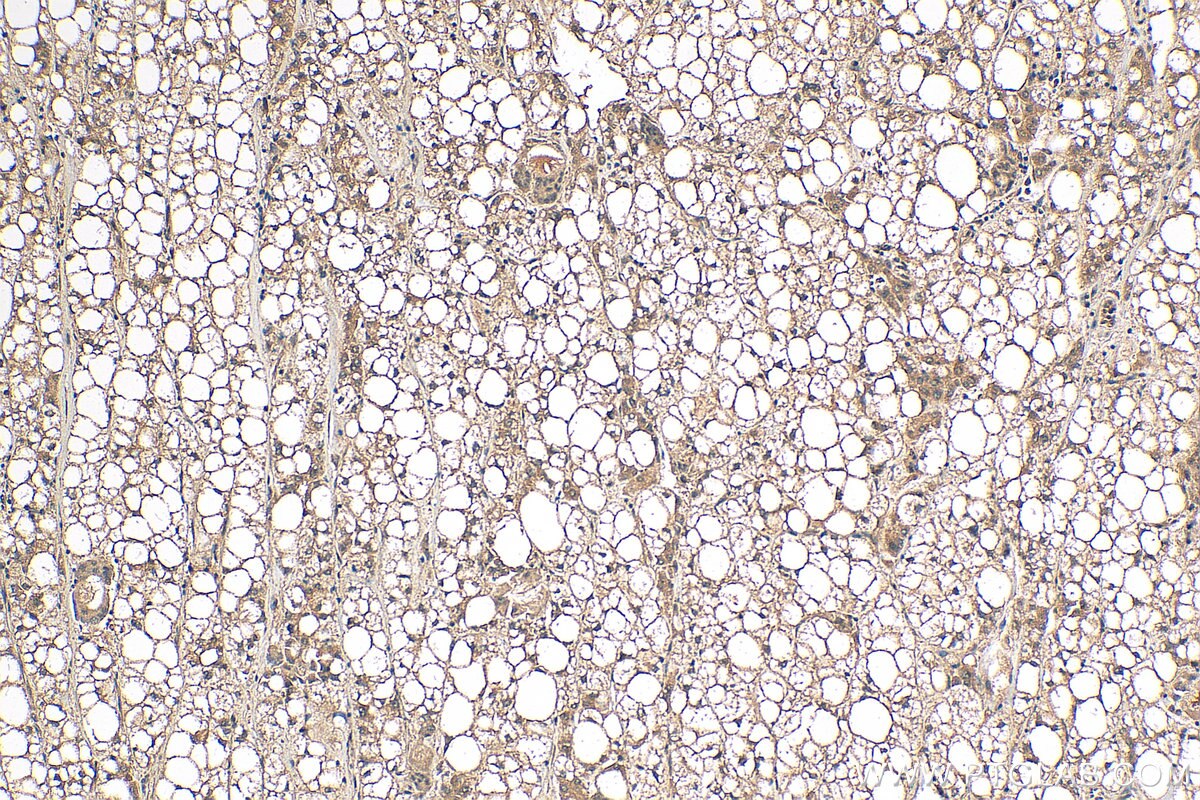 Immunohistochemistry (IHC) staining of human liver cancer tissue using MKL1/MRTF-A Polyclonal antibody (21166-1-AP)
