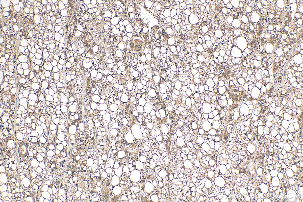 Immunohistochemistry (IHC) staining of human liver cancer tissue using MKL1 Polyclonal antibody (21166-1-AP)