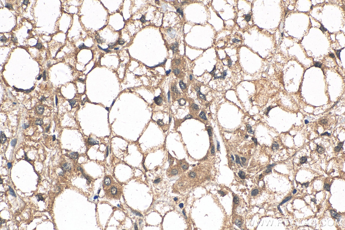 Immunohistochemistry (IHC) staining of human liver cancer tissue using MKL1 Polyclonal antibody (21166-1-AP)