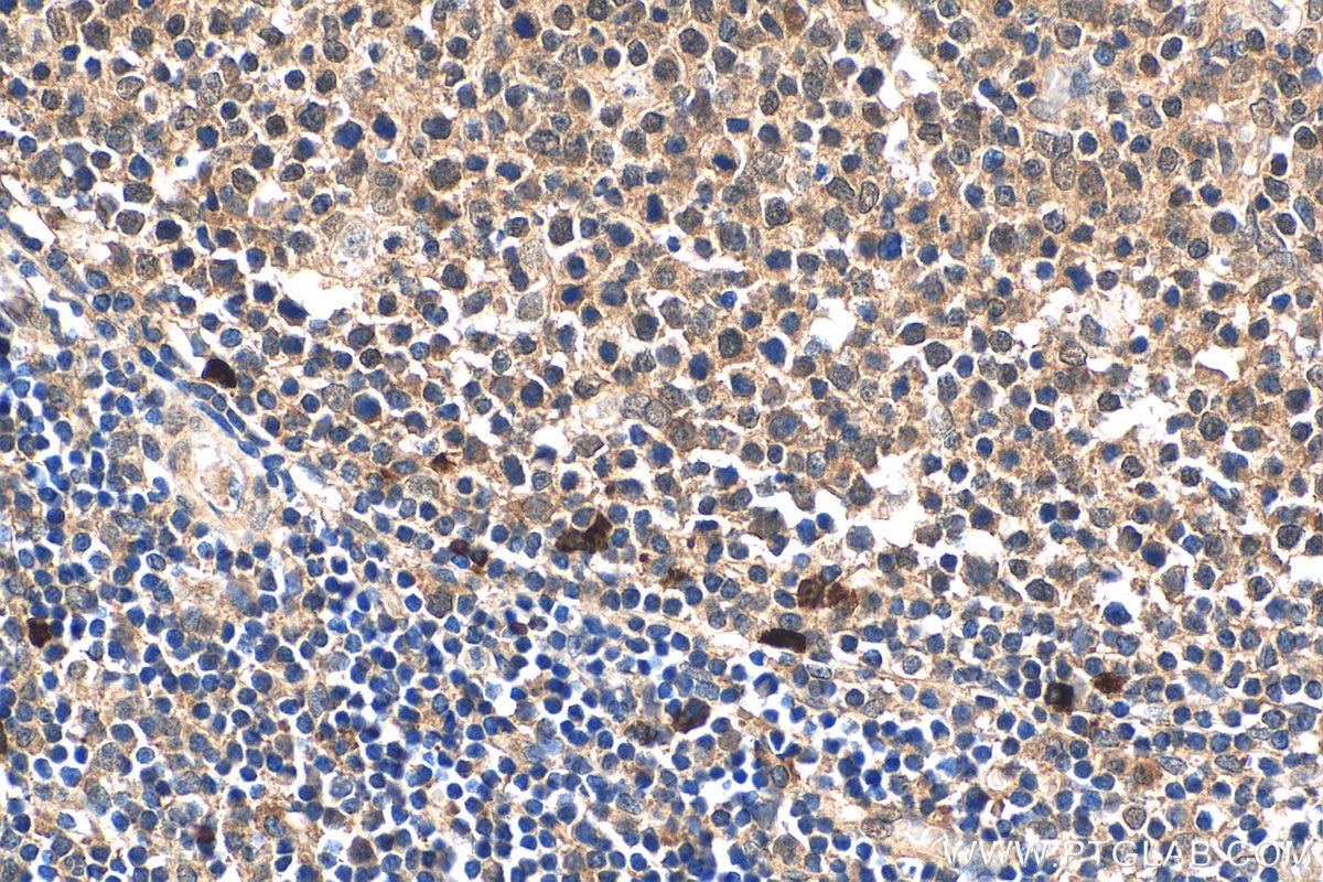 Immunohistochemistry (IHC) staining of human tonsillitis tissue using MKL1 Polyclonal antibody (21166-1-AP)