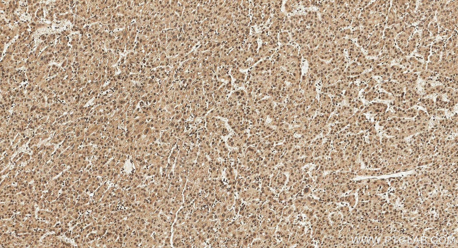 Immunohistochemistry (IHC) staining of human liver cancer tissue using MKL1/MRTF-A Polyclonal antibody (21166-1-AP)