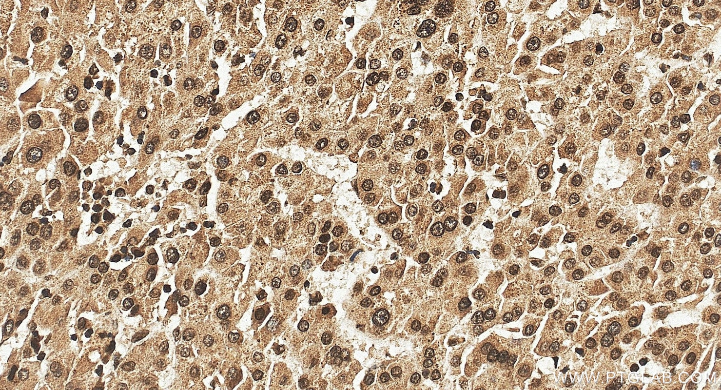 Immunohistochemistry (IHC) staining of human liver cancer tissue using MKL1/MRTF-A Polyclonal antibody (21166-1-AP)