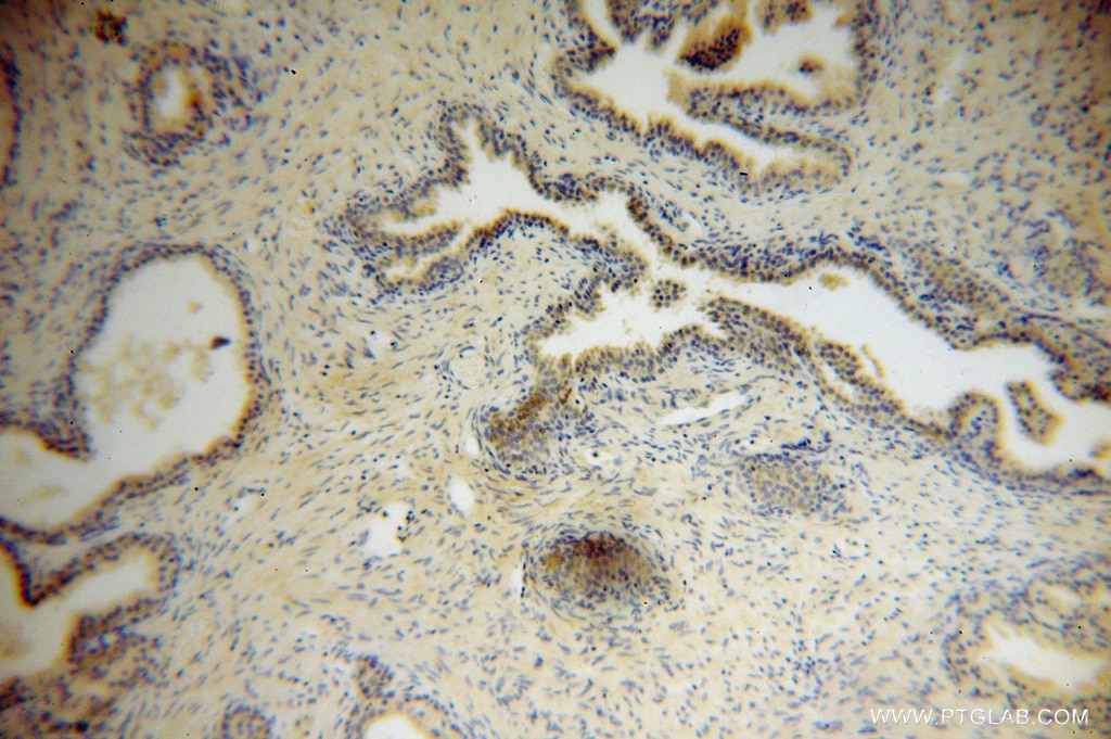 Immunohistochemistry (IHC) staining of human gliomas tissue using Muskelin Polyclonal antibody (14735-1-AP)
