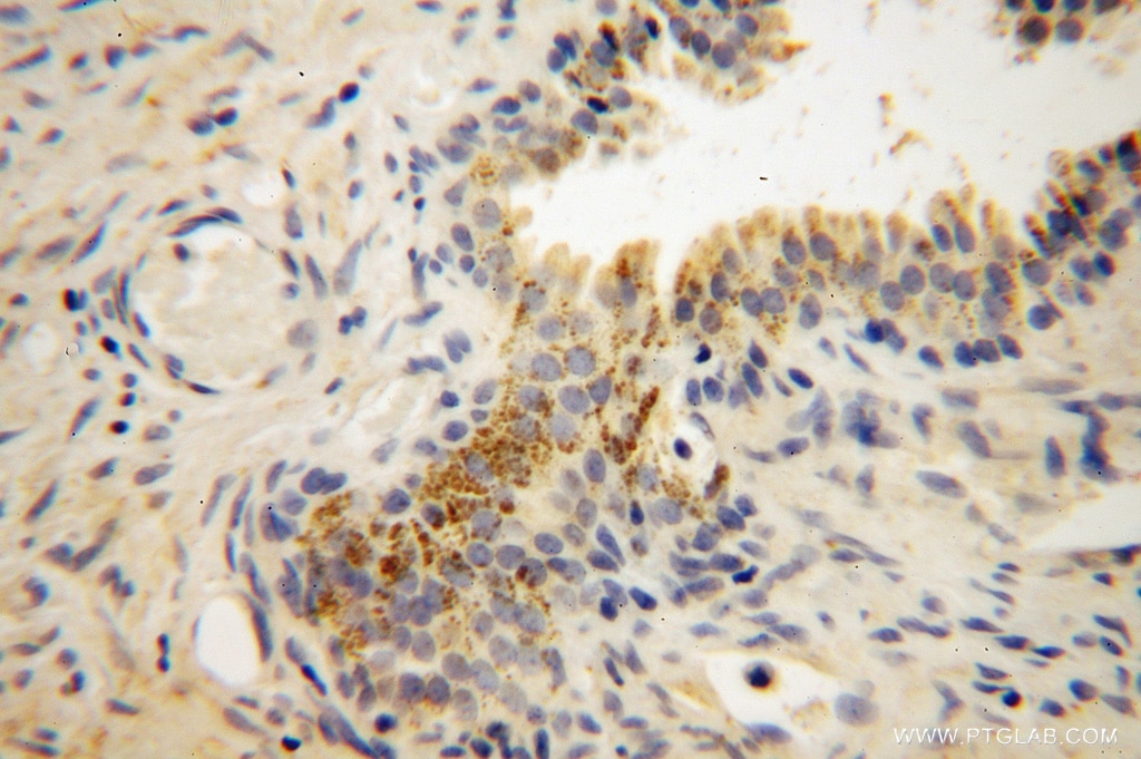 Immunohistochemistry (IHC) staining of human gliomas tissue using Muskelin Polyclonal antibody (14735-1-AP)